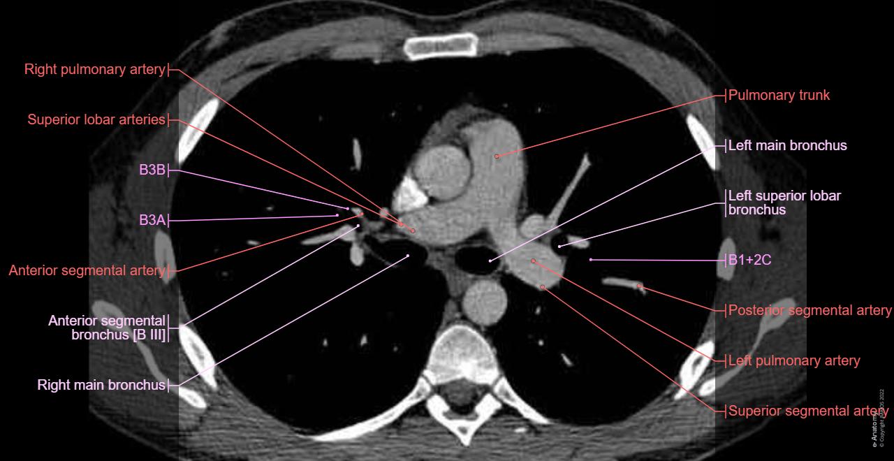 Axial Ct Anatomy Head And Spine Anatomy Radiology Cafe