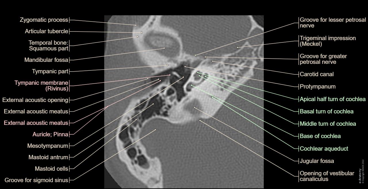 Temporal Bone Anatomy Ct