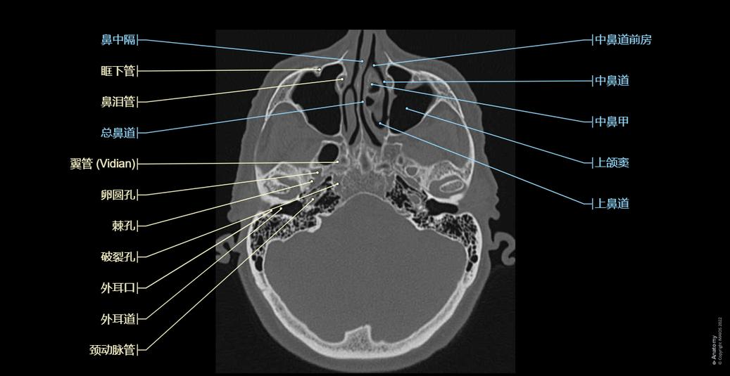 头部 CT : 正常解剖 | e-Anatomy