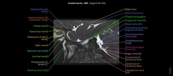 Navicular Cortex Mri Anatomy of the cranial nerves and brainstem: annotated MRI | e-Anatomy