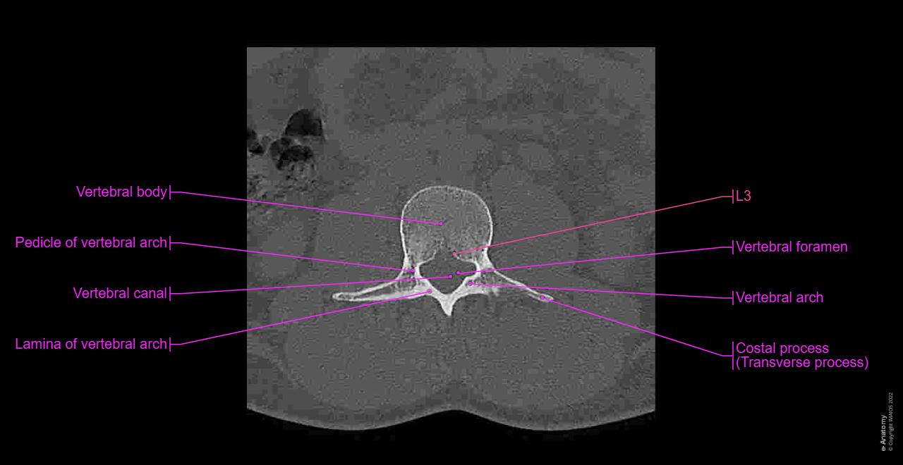 L1 Accessory Rib lumbar spine: normal anatomy | e-Anatomy