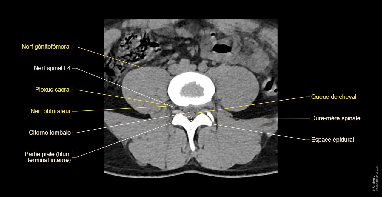 Rachis Lombaire TDM Anatomie Normale E Anatomy rachis-lombaire-tdm-anatomie-normale-e-anatomy