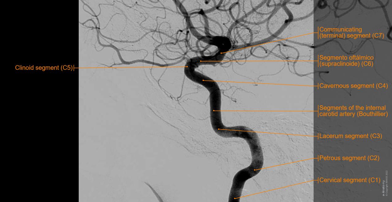 Normal Labelled Angiogram Artérias do encéfalo Angiografia : anatomia normal | e-Anatomy