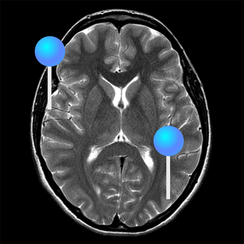 脳 軸位断によるMRI : 正常解剖学 | e-Anatomy 脳 軸位断によるMRI : 正常解剖学 | e-Anatomy