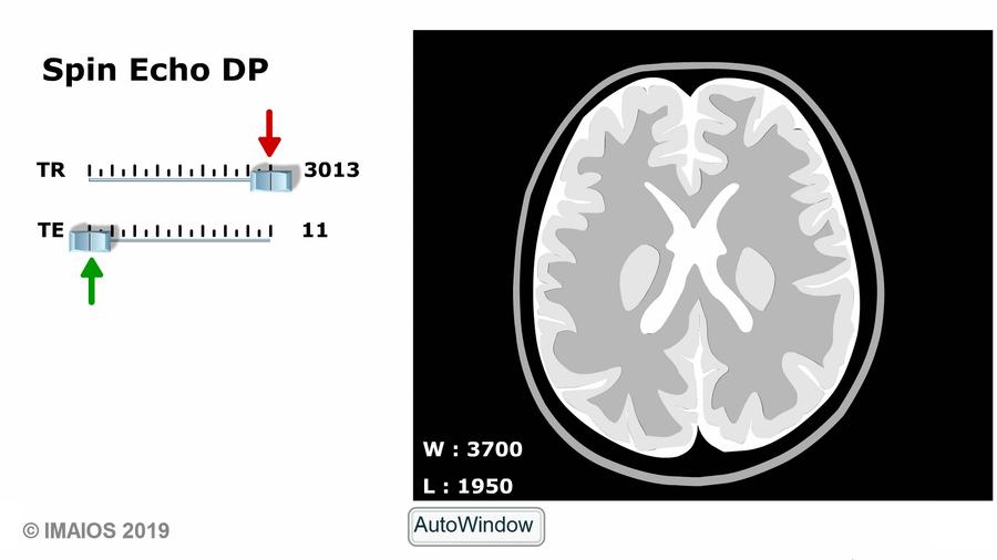 MRI Sequences: spin echo | e-MRI