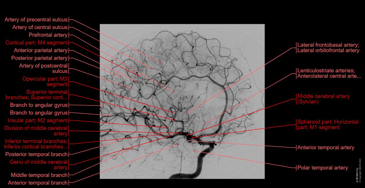 What Is An Arterial Angiogram what-is-an-arterial-angiogram