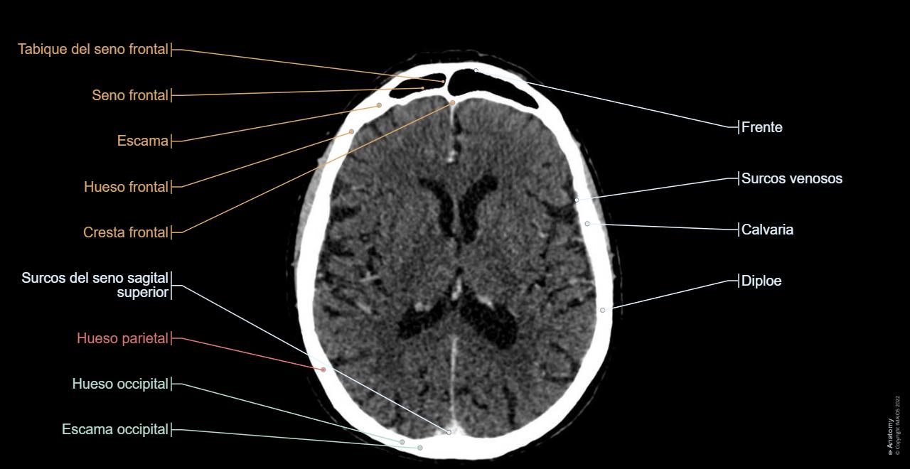 Tac Normal Tomografía Computarizada Del Cerebro