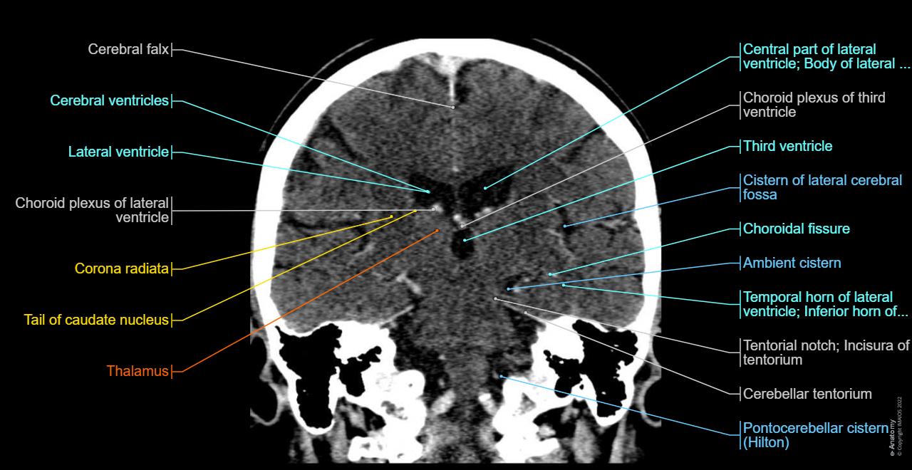 Normal Anatomy Of The Brain On Ct And Mri With A Few Normal Variants
