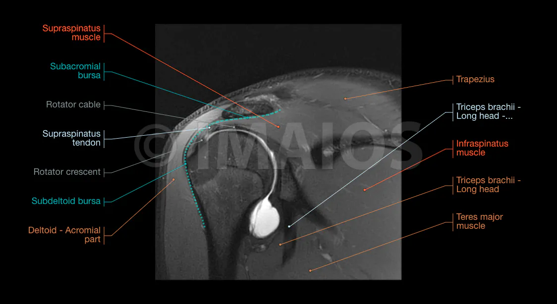 Shoulder MR Arthrogram | e-Anatomy