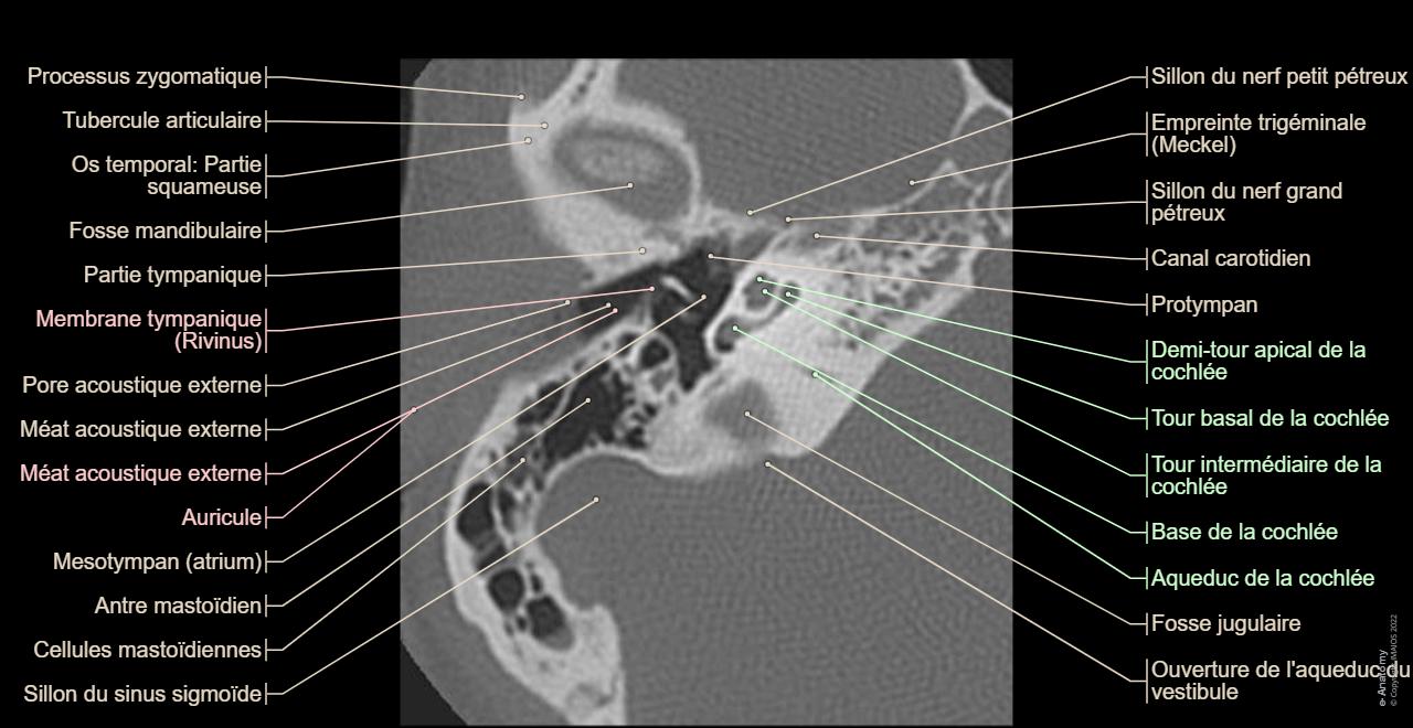 Fracture Rocher Rocher TDM: anatomie normale | e-Anatomy