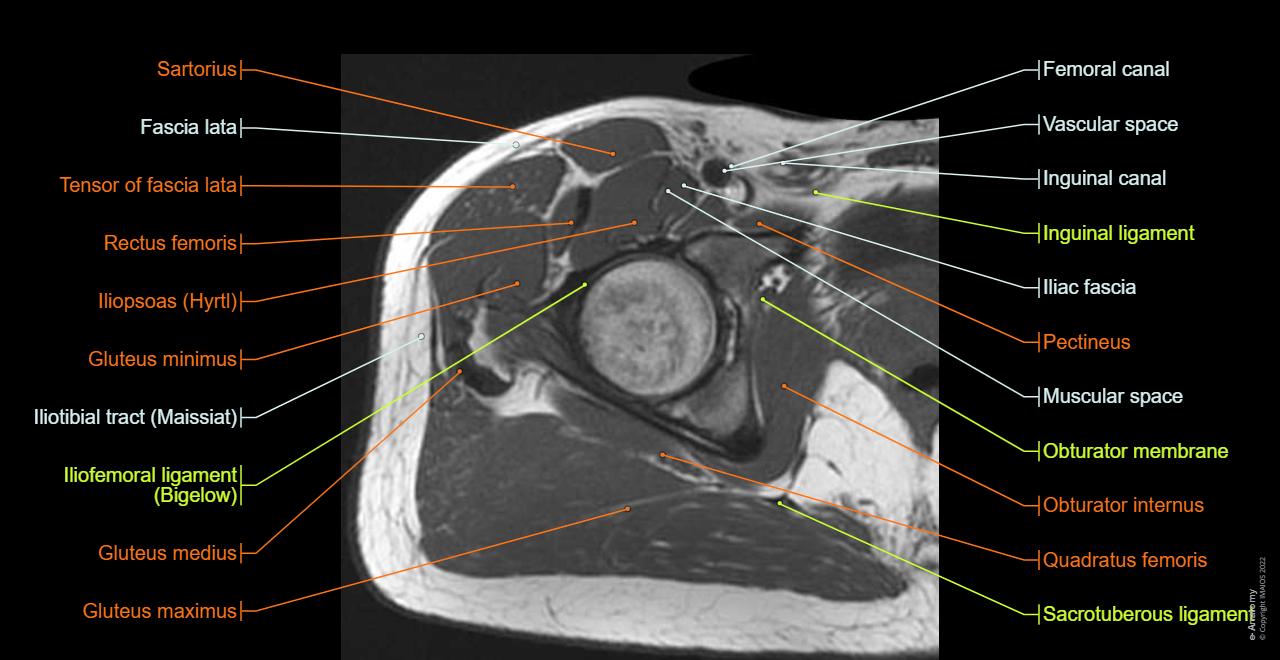 Hip Mri Anatomy Pericapsular Nerve Group Block: A 3D CT Scan Imaging