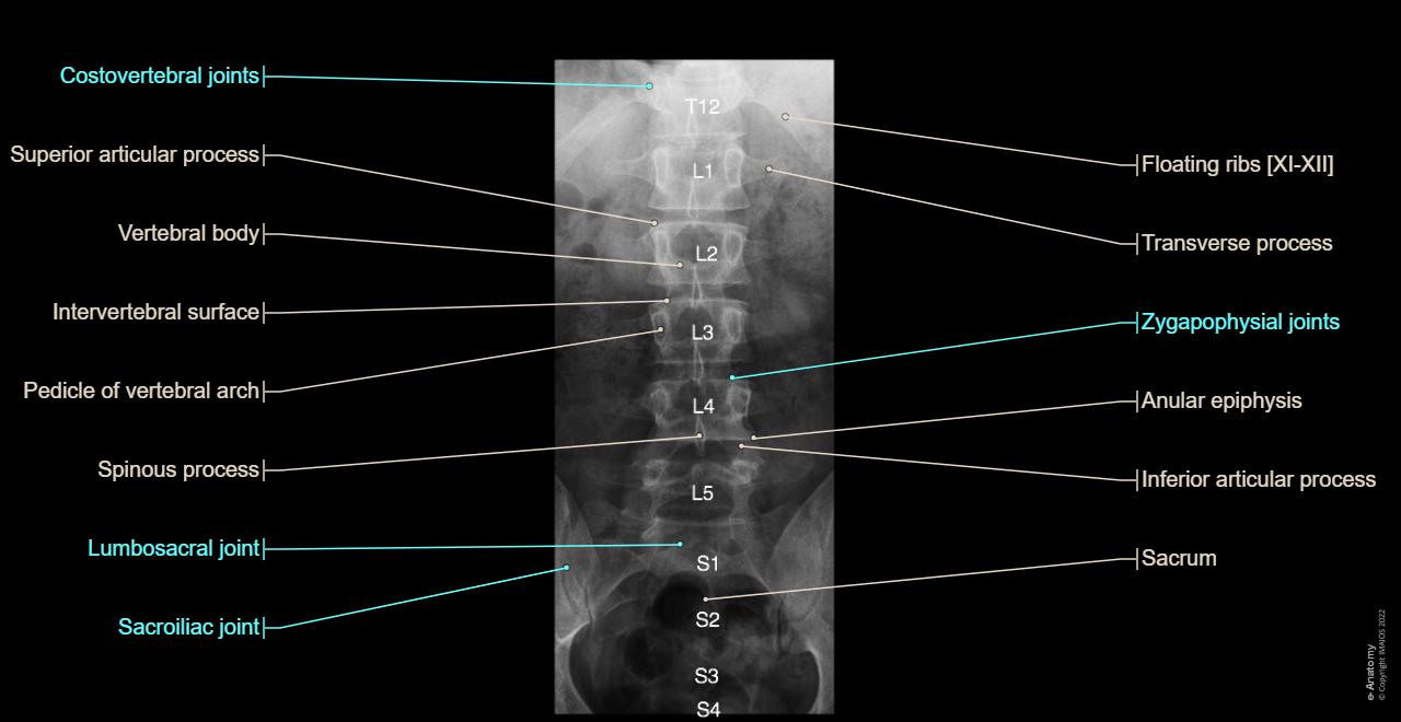 Lumbar spine AP X-ray with anatomy labels