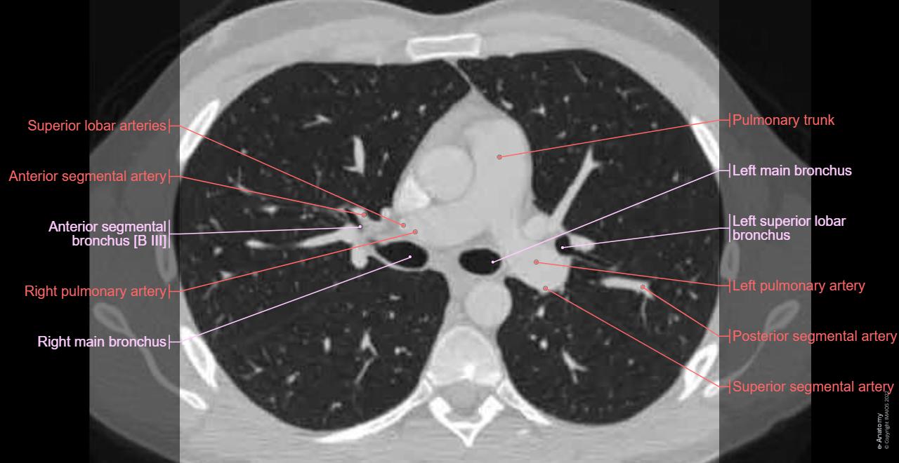 Radiopaedia Lung Segments The Radiology Assistant : Lung Segments And