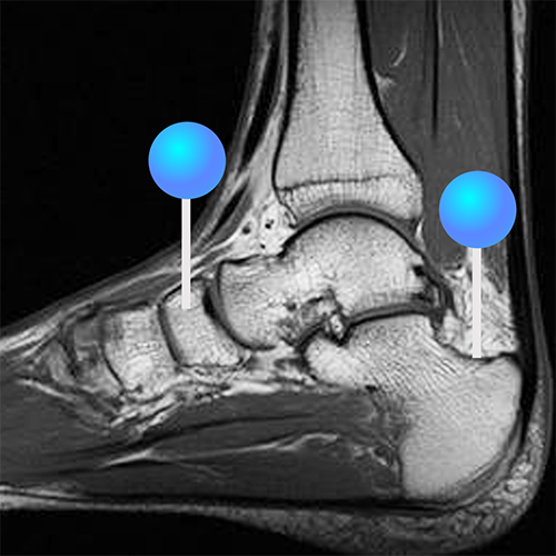 関節のMRI 足関節 - 足部 MRI : 正常解剖学 | e-Anatomy
