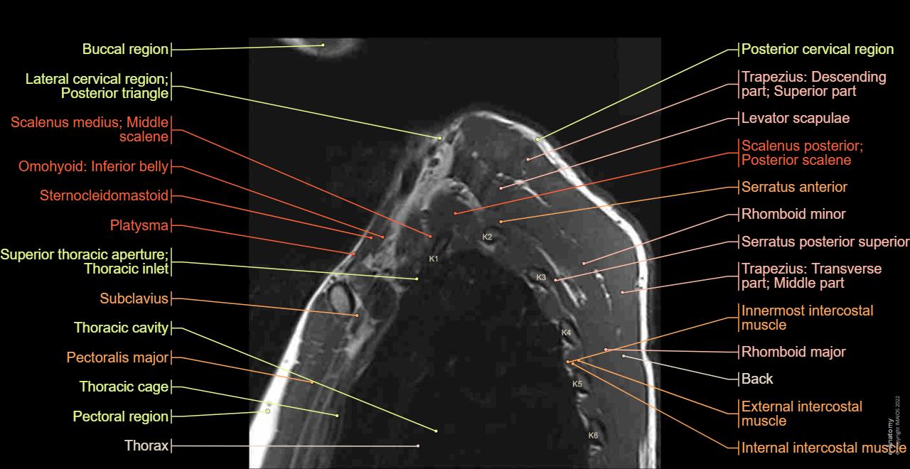 Thoracic Inlet Radiology Brachial plexus MR: normal anatomy | e-Anatomy