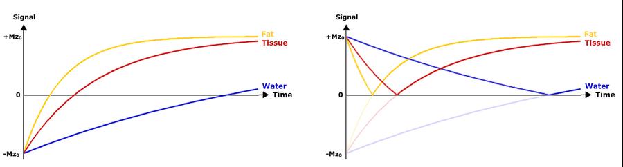 MRI sequences: Inversion Recovery, STIR and FLAIR | e-MRI