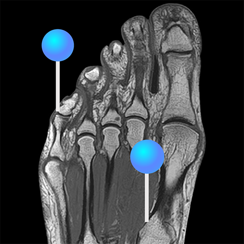 Midfoot Radiology Anatomy of the midfoot, forefoot and toes: annotated MRI | e-Anatomy