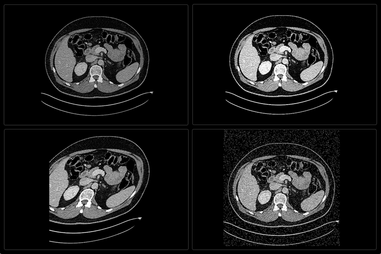 Medical Image Augmentation Deep learning in medical imaging: data augmentation