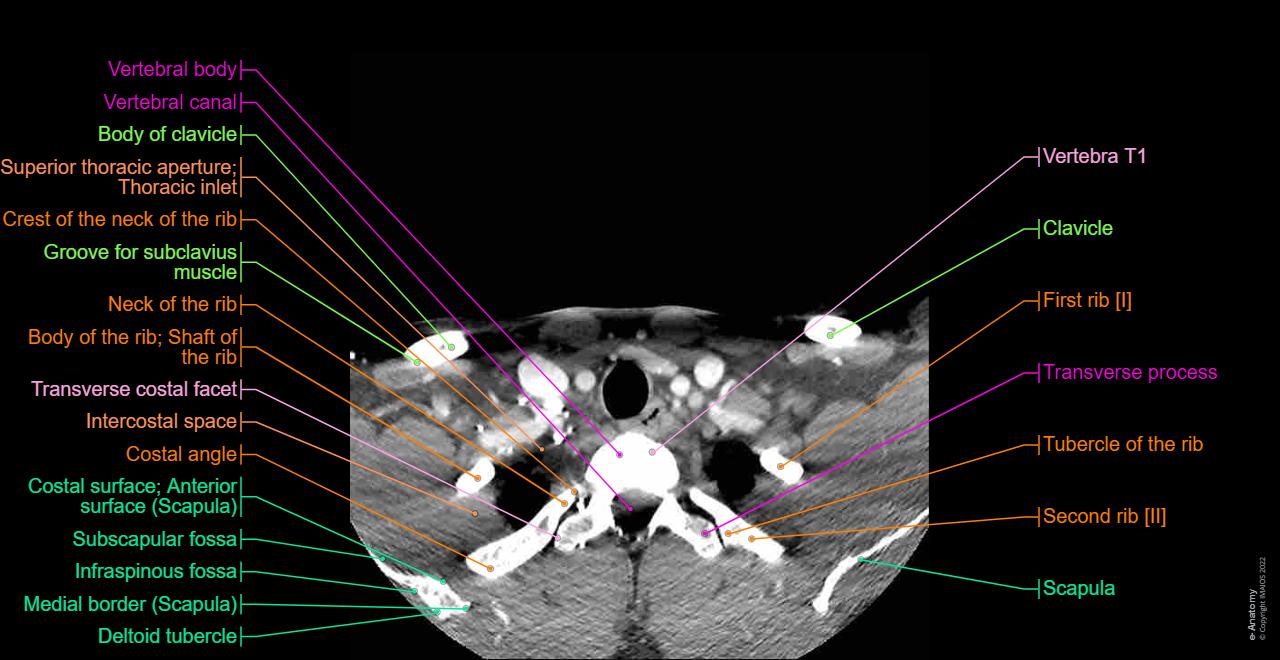 Neck Ct Anatomy NORMAL ANATOMY OF THE NECK WITH CT AND MR IMAGING