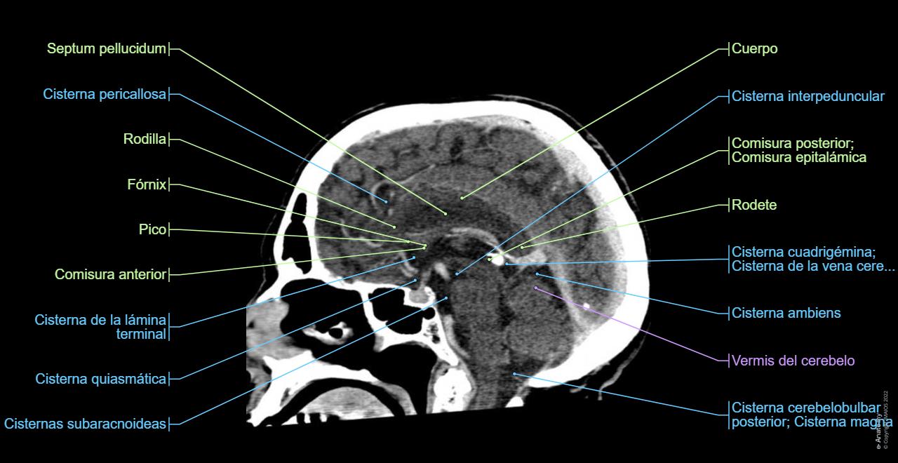 Anatomía Del Cuello Por Tc 06. Vísceras Del Cuello | Enfermería