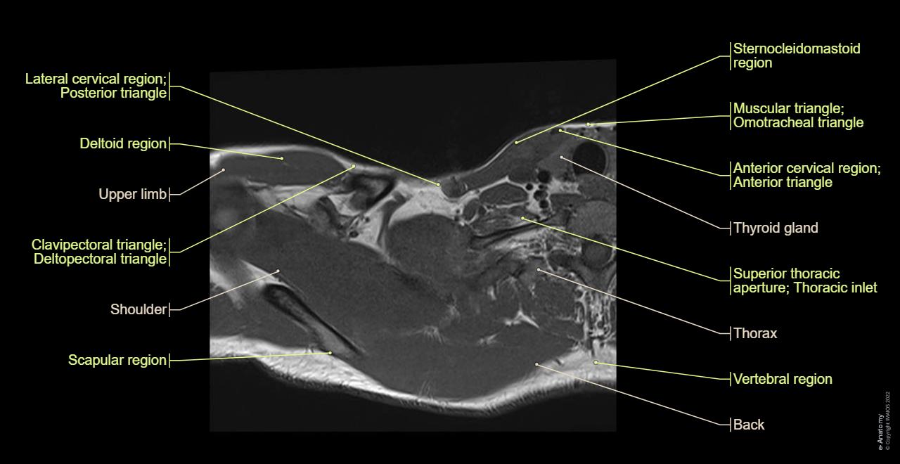 Brachial plexus MR: normal anatomy | e-Anatomy