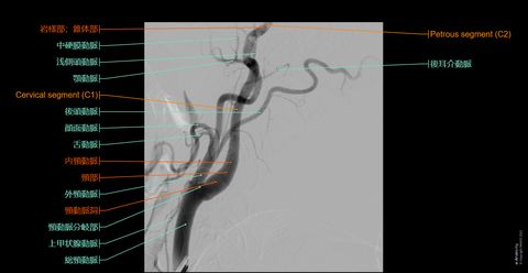 脳動脈 血管造影 : 正常解剖学 | e-Anatomy