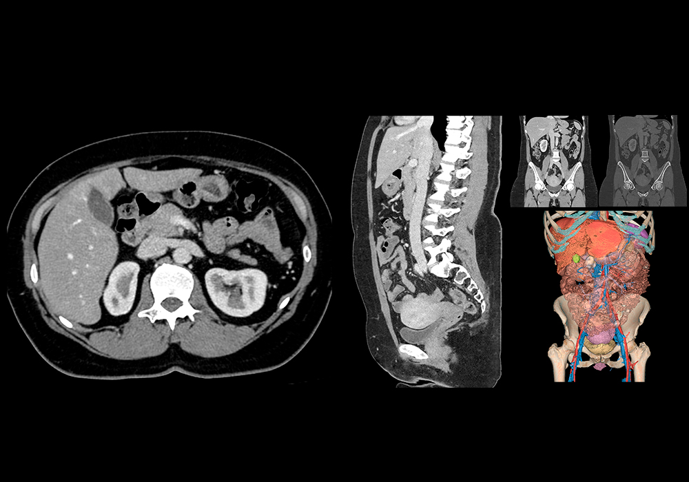 Anatomy of the female abdomen and pelvis on CT - e-Anatomy