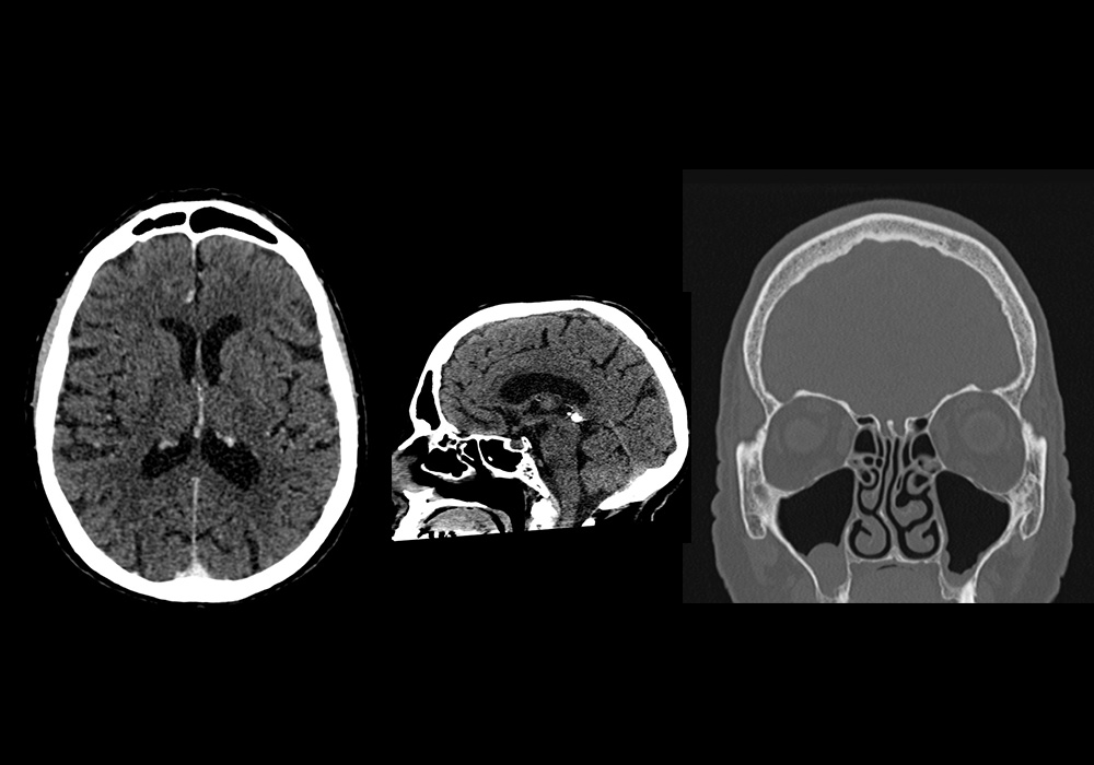 头部 CT : 正常解剖 | e-Anatomy