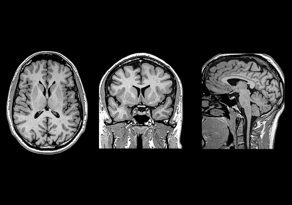 뇌 MRI 3D: 정상 해부학 |e-Anatomy