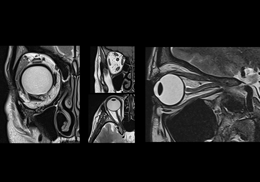 Anatomy of the orbits: annotated MRI | e-Anatomy