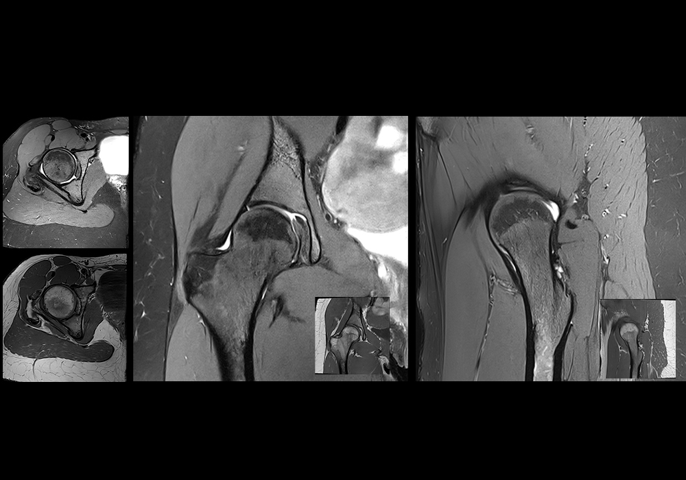 Anatomy of the hip: labeled MRI - e-Anatomy