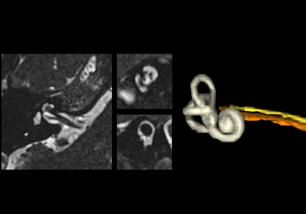 Anatomy of the inner ear and internal auditory canal: annotated MRI | e ...