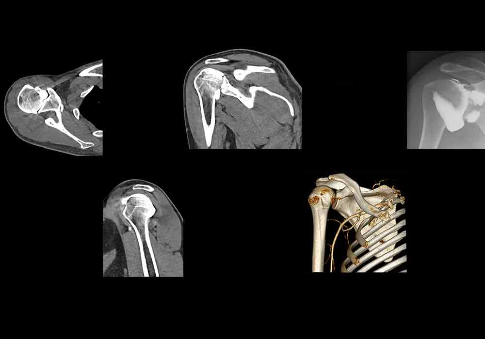 CT arthrogram of the shoulder joint: normal anatomy | e-Anatomy