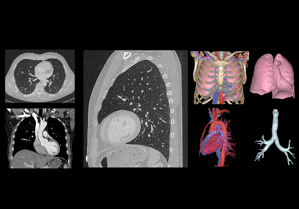 Anatomia Dos Pulm es Mediastino E Cora o Em TAC tomografia Tor cica anatomia-dos-pulm-es-mediastino-e-cora-o-em-tac-tomografia-tor-cica